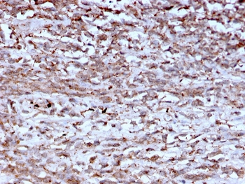 Cathepsin K Antibody Hepatocellular Carcinoma IHC. Immunohistochemistry analysis of FFPE human hepatocellular carcinoma using Cathepsin K antibody (clone CTSK/2793) shows granular cytoplasmic staining in tumor cells, consistent with CTSK / Cathepsin K localization in lysosomal compartments, with variable intensity across the tumor field. The punctate staining pattern reflects lysosomal protease activity associated with extracellular matrix remodeling in malignant tissue. Tumor architecture is preserved, and hematoxylin counterstain provides nuclear contrast and structural context. HIER: boil FFPE tissue sections in pH 9 10 mM Tris with 1 mM EDTA for 10-20 min and allow to cool before testing.