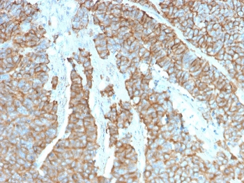 Drebrin 1 Antibody Neuroendocrine Tumor Immunohistochemistry. IHC staining of FFPE human neuroendocrine tumor with Drebrin 1 antibody (clone DBN1/3393). HIER: boil tissue sections in pH 9 10mM Tris with 1mM EDTA for 10-20 min followed by cooling at RT for 20 min.