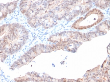 AKR1C2 Antibody Prostate Carcinoma IHC. Immunohistochemistry analysis of FFPE human prostate carcinoma tissue using AKR1C2 Antibody (clone CPTC-AKR1C2-1) shows cytoplasmic staining in tumor epithelial cells, consistent with AKR1C2 / Aldo-keto reductase family 1 member C2 localization as a cytosolic enzyme involved in hormone metabolism. The staining outlines glandular tumor structures with variable intensity across the tumor field, while surrounding stromal regions display comparatively lower signal. Hematoxylin counterstain provides nuclear contrast and tissue architecture. HIER: boil FFPE tissue sections in pH 9 10 mM Tris with 1 mM EDTA for 10-20 min and allow to cool before testing.