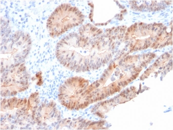 AKR1C2 Antibody Prostate Tumor Gland IHC. Immunohistochemistry analysis of FFPE human prostate carcinoma tissue using AKR1C2 Antibody (clone CPTC-AKR1C2-1) shows cytoplasmic staining in tumor epithelial cells lining glandular structures, consistent with AKR1C2 / Aldo-keto reductase family 1 member C2 localization as a cytosolic enzyme involved in hormone metabolism. The staining highlights glandular architecture with moderate intensity across epithelial cells, while surrounding stromal regions display comparatively lower signal. Hematoxylin counterstain provides nuclear contrast and tissue context. HIER: boil FFPE tissue sections in pH 9 10 mM Tris with 1 mM EDTA for 10-20 min and allow to cool before testing.