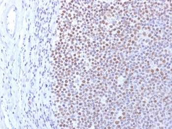 DNA Methyltransferase 1 Antibody Human Tonsil IHC. Immunohistochemistry staining of FFPE human tonsil using DNA Methyltransferase 1 antibody demonstrates strong nuclear staining throughout the lymphoid compartment, consistent with the expected localization of DNMT1 as a nuclear DNA methylation maintenance enzyme. DNMT1 functions to preserve genomic methylation patterns during DNA replication and plays a critical role in epigenetic regulation, chromatin organization, and transcriptional control. The prominent nuclear staining observed within proliferative tonsillar lymphocytes is consistent with the established role of DNMT1 in maintaining cellular identity and epigenetic stability in actively dividing cell populations. HIER: boil tissue sections in pH 9 10mM Tris with 1mM EDTA for 10-20 min and allow to cool before testing.