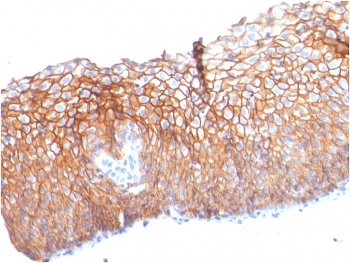 Immunohistochemistry of DSG3 Antibody - Microarray Validated clone DSG3/2840 in human esophageal carcinoma tissue. Formalin-fixed, paraffin-embedded esophageal carcinoma demonstrates strong membranous staining of tumor epithelial cells, consistent with Desmoglein 3 localization at desmosomal cell-cell junctions in stratified squamous epithelium-derived malignancy. Heat-induced epitope retrieval was performed by boiling tissue sections in pH 9 10mM Tris with 1mM EDTA for 10-20 minutes followed by cooling prior to staining. The microarray validated monoclonal antibody clone DSG3/2840 was used as the primary antibody.
