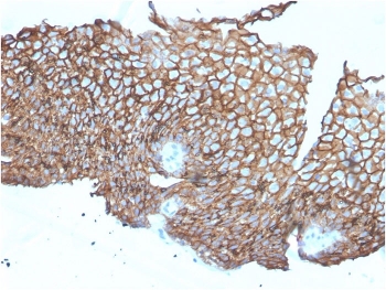 IHC staining of FFPE human esophageal carcinoma with DSG3 antibody-microarray validated clone DSG3/2840. HIER: boil tissue sections in pH 9 10mM Tris with 1mM EDTA for 10-20 min and allow to cool before testing.