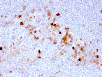 CD105 Antibody Tonsil Vascular IHC. Immunohistochemistry analysis of FFPE human tonsil tissue using CD105 Antibody (clone ENG/3269) demonstrates HRP-DAB brown membranous staining in endothelial cells of small vessels within lymphoid regions, with scattered vascular profiles highlighted throughout the tissue, consistent with Endoglin / CD105 expression as an endothelial marker, while surrounding lymphocytes remain largely negative; nuclei are counterstained blue. HIER: boil tissue sections in pH 9 10 mM Tris with 1 mM EDTA for 10-20 min and allow to cool before testing.