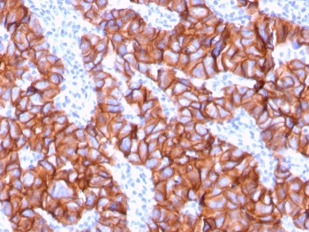 HER2 Antibody Breast Tumor Surface IHC. Immunohistochemistry analysis of FFPE human breast carcinoma tissue using HER2 Antibody (clone ERBB2/3078) highlights continuous HRP-DAB brown membranous staining across tumor cell clusters, emphasizing cell surface localization of ErbB2 / HER2 consistent with an antibody generated against an extracellular portion of the receptor, while adjacent stromal regions remain largely negative; nuclei are counterstained blue. HIER: boil tissue sections in pH 9 10 mM Tris with 1 mM EDTA for 10-20 min and allow to cool before testing.