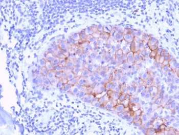 HER2 Antibody Breast Tumor Focal IHC. Immunohistochemistry analysis of FFPE human breast carcinoma tissue using HER2 Antibody (clone ERBB2/3078) demonstrates moderate to strong HRP-DAB brown membranous staining in focal tumor regions, consistent with variable ErbB2 / HER2 expression at the cell surface and detection within an extracellular region of the receptor, while surrounding stromal components show minimal background staining; nuclei are counterstained blue. HIER: boil tissue sections in pH 9 10 mM Tris with 1 mM EDTA for 10-20 min and allow to cool before testing.