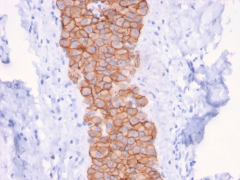 HER2 Antibody Breast Tumor Columnar IHC. Immunohistochemistry analysis of FFPE human breast carcinoma tissue using HER2 Antibody (clone ERBB2/3079) highlights intense, continuous HRP-DAB brown membranous staining along elongated tumor cell structures, emphasizing cell surface localization of ErbB2 / HER2 within organized epithelial arrangements, while adjacent stromal regions remain largely negative; nuclei are counterstained blue. HIER: boil tissue sections in pH 9 10 mM Tris with 1 mM EDTA for 10-20 min and allow to cool before testing.