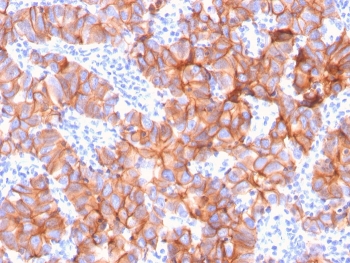 HER2 Antibody Breast Tumor Architecture IHC. Immunohistochemistry analysis of FFPE human breast carcinoma tissue using HER2 Antibody (clone ERBB2/3079) demonstrates widespread HRP-DAB brown membranous staining across complex tumor glandular architecture, consistent with high-level ErbB2 / HER2 expression as a membrane-associated receptor tyrosine kinase, while stromal components show minimal background staining; nuclei are counterstained blue. HIER: boil tissue sections in pH 9 10 mM Tris with 1 mM EDTA for 10-20 min and allow to cool before testing.