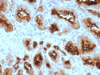 Folate Hydrolase 1 Antibody Prostate Cancer IHC. Immunohistochemistry analysis of FFPE human prostate carcinoma tissue stained with Folate Hydrolase 1 Antibody / Folate Metabolism Marker. Malignant glandular epithelial cells demonstrate strong membranous and apical cytoplasmic HRP-DAB brown staining consistent with expression of Folate hydrolase 1 / FOLH1, also known as Prostate-specific membrane antigen / PSMA, a membrane-associated metallopeptidase involved in folate metabolism and prostate tumor-associated signaling pathways. Required HIER: boil tissue sections in pH 9 10mM Tris with 1mM EDTA for 10-20 min and allow to cool before testing.