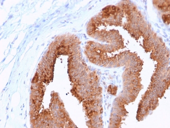 HER4 Antibody Breast Carcinoma Glandular IHC. Immunohistochemistry analysis of FFPE human breast carcinoma stained with a mouse monoclonal HER4 antibody (clone ERBB4/2581) shows strong HRP-DAB brown membranous and cytoplasmic staining in tumor epithelial cells forming glandular structures, consistent with ERBB4 expression, while surrounding stromal regions display minimal background; heat-induced epitope retrieval was performed in pH 9 Tris-EDTA buffer.
