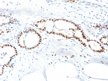 IHC staining of FFPE human breast carcinoma with Estrogen Receptor alpha antibody (clone ESR1/1904). HIER: boil tissue sections in pH 9 10mM Tris with 1mM EDTA for 10-20 min and allow to cool before testing.