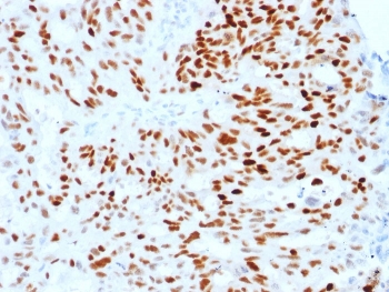 Estrogen Receptor alpha Antibody FFPE Endometrial Carcinoma IHC. Immunohistochemistry staining of FFPE human endometrial carcinoma with Estrogen Receptor alpha antibody (clone ESR1/1904). HIER: boil tissue sections in pH 9 10mM Tris with 1mM EDTA for 10-20 min and allow to cool before testing.