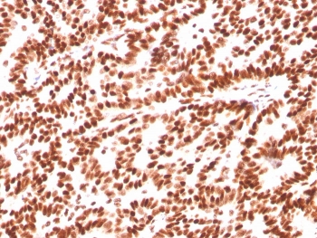 Estrogen Receptor alpha Antibody Breast Carcinoma IHC. Immunohistochemistry of FFPE human breast carcinoma tissue using Estrogen Receptor alpha antibody shows strong HRP-DAB brown nuclear staining in tumor epithelial cells, consistent with ESR1 expression in hormone-responsive breast cancer, while surrounding stromal cells display minimal background; detection was performed with clone ESR1/3559. HIER: boil tissue sections in pH 9 10mM Tris with 1mM EDTA for 10-20 min and allow to cool before testing.
