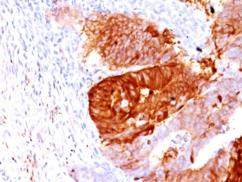 ALDH1A1 Antibody Colon Carcinoma IHC. Immunohistochemistry staining of FFPE human colon carcinoma with ALDH1A1 antibody (clone ALDH1A1/1381). HIER: boil tissue sections in pH 9 10mM Tris with 1mM EDTA for 10-20 min and allow to cool before testing.