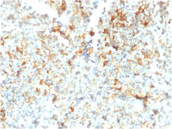 FCGRT Antibody Testicular Cancer IHC. Immunohistochemistry analysis of FFPE human testicular cancer tissue stained with FCGRT Antibody / Neonatal Fc Receptor clone FCGRT/2932 following HIER in pH 9 Tris-EDTA buffer. HRP-DAB brown cytoplasmic and membranous staining is observed in malignant cell populations, consistent with expression of FcRn/FCGRT, an IgG transport receptor involved in antibody recycling, Fc-mediated transport, and regulation of immunoglobulin homeostasis.