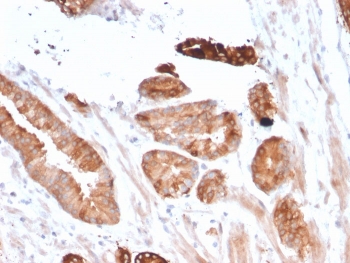 CD135 Antibody Breast Carcinoma Immunohistochemistry. IHC staining of FFPE human breast carcinoma with CD135 antibody (clone FLT3/2458). HIER: boil tissue sections in pH 9 10mM Tris with 1mM EDTA for 10-20 min and allow to cool before testing.