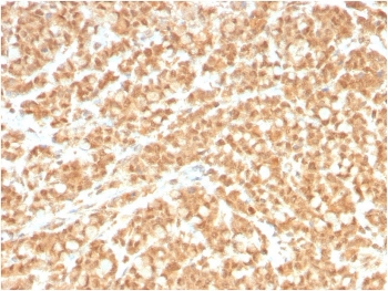 ICOS Ligand Antibody Colon Carcinoma IHC. Immunohistochemistry analysis of FFPE human colon carcinoma tissue stained with clone ICOSL/3260. Tumor epithelial cells display diffuse membranous and cytoplasmic HRP-DAB brown staining consistent with expression of Inducible T-cell costimulator ligand / ICOSLG, an immune checkpoint-associated B7 family ligand involved in adaptive immune signaling and regulation of T-cell activation within the tumor microenvironment. Stromal elements demonstrate comparatively weaker background staining. HIER: boil tissue sections in pH 9 10mM Tris with 1mM EDTA for 10-20 min and allow to cool before testing.