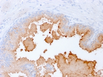 AMACR/p504S Antibody Human Prostate Carcinoma Tissue Immunohistochemistry. IHC staining of FFPE human prostate carcinoma with recombinant AMACR/p504S antibody (clone rAMACR/1864). HIER: boil tissue sections in pH 9 10mM Tris with 1mM EDTA for 10-20 min and allow to cool before testing.