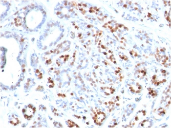 GATA3 Antibody Breast Carcinoma IHC. Immunohistochemistry analysis of FFPE human breast carcinoma tissue stained with clone GATA3/2444 demonstrates strong nuclear HRP-DAB brown staining within malignant epithelial cells, consistent with the established role of GATA binding protein 3 / GATA3 as a breast lineage-associated transcription factor involved in luminal epithelial differentiation.