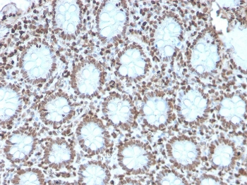 Histone H1 Antibody for IHC. Immunohistochemistry analysis of replication-associated histone H1 expression in FFPE human colon carcinoma tissue using Histone H1 Antibody. Nuclear HRP-DAB brown staining is observed in tumor epithelial cells, consistent with localization of linker histone H1 within chromatin and its role in chromatin organization during replication-coupled chromatin assembly. The recombinant rabbit clone AE-4 antibody demonstrates strong nuclear compartmentalization with minimal cytoplasmic staining, reflecting chromatin-associated distribution in proliferative tumor regions.