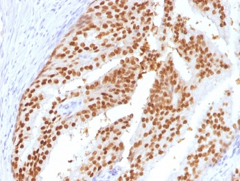 FOXA1 Antibody Prostatic Intraepithelial Neoplasia (PIN) IHC. Immunohistochemical staining of FFPE human prostatic intraepithelial neoplasia (PIN) tissue using FOXA1 Antibody (clone FOXA1/1516) demonstrates strong nuclear HRP-DAB brown staining within dysplastic prostatic epithelial cells. The staining pattern is consistent with expression of FOXA1, a forkhead family transcription factor that functions as a developmental regulator of gene expression, epithelial differentiation, and tissue-specific transcriptional programs. The prominent nuclear localization is characteristic of a DNA-binding transcription factor and supports the role of FOXA1 in maintaining epithelial lineage identity and regulating gene networks associated with cellular differentiation and prostate epithelial biology. HIER: steam sections in pH 9 10 mM Tris with 1 mM EDTA for 10-20 minutes and allow to cool before testing.