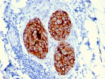 HER-2 Antibody FFPE Human Breast Cancer Tissue IHC. Immunohistochemistry analysis of FFPE human breast carcinoma tissue using HER-2 antibody (clone ERBB2/3080). Brown chromogenic signal indicates HER-2-positive membranous staining in tumor epithelial cell clusters. Heat-induced epitope retrieval was performed by boiling tissue sections in pH 9 10mM Tris with 1mM EDTA for 10â20 minutes, followed by cooling prior to antibody incubation.