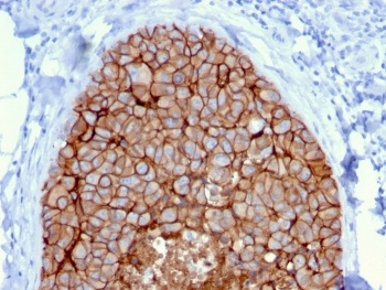 HER-2 Antibody Breast Carcinoma Cluster IHC. Immunohistochemistry analysis of FFPE human breast carcinoma tissue using HER-2 Antibody (clone ERBB2/3080) demonstrates strong HRP-DAB brown membranous staining in compact tumor cell clusters, consistent with ErbB2 / HER2 expression as a cell surface receptor, while surrounding stromal tissue shows minimal signal; nuclei are counterstained blue. HIER: boil tissue sections in pH 9 10 mM Tris with 1 mM EDTA for 10-20 min and allow to cool before testing.