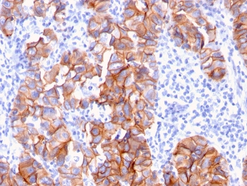 HER2 Antibody Breast Tumor Patchy IHC. Immunohistochemistry analysis of FFPE human breast carcinoma tissue using HER-2 Antibody (clone ERBB2/3093) highlights patchy yet distinct HRP-DAB brown membranous staining across tumor cell groups, reflecting variable ErbB2 / HER2 expression within the tumor microenvironment, while adjacent stromal regions remain largely negative; nuclei are counterstained blue. HIER: boil tissue sections in pH 9 10 mM Tris with 1 mM EDTA for 10-20 min and allow to cool before testing.