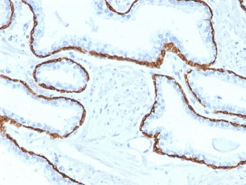 IHC staining of FFPE human prostate carcinoma with Cytokeratin 5 antibody (clone KRT5/2080). HIER: boil tissue sections in pH 9 10mM Tris with 1mM EDTA for 20 min and allow to cool before testing.