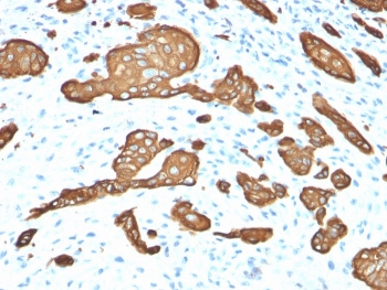 Cytokeratin 8 Antibody Basal Cell Carcinoma IHC. Immunohistochemistry staining of FFPE human basal cell carcinoma tissue using Cytokeratin 8 Antibody / Protein Microarray Validated Antibody (clone KRT8/2115) demonstrates strong membranous and cytoplasmic HRP-DAB brown staining within nests and cords of neoplastic epithelial cells. The staining pattern is consistent with expression of Keratin 8 (KRT8), a type II intermediate filament protein involved in epithelial cell structure, cytoskeletal organization, and tissue integrity. Prominent immunoreactivity sharply highlights tumor cell populations against the surrounding stromal background and supports the established role of KRT8 as a marker of epithelial differentiation. The observed staining demonstrates the utility of this antibody for studies of epithelial biology, skin cancer pathology, intermediate filament organization, and epithelial-derived neoplasms. HIER: boil tissue sections in pH 9, 10 mM Tris with 1 mM EDTA for 20 minutes and allow to cool before testing.