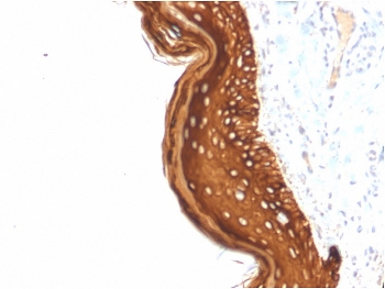 IHC staining of FFPE human basal cell carcinoma with Cytokeratin 15 antibody (clone KRT15/2957). HIER: boil tissue sections in pH 9 10mM Tris with 1mM EDTA for 10-20 min and allow to cool before testing.