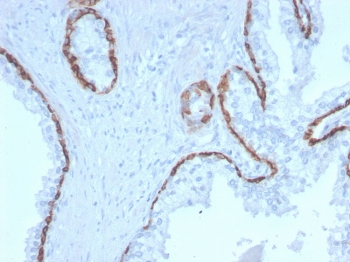 IHC staining of FFPE human prostate carcinoma with Keratin 15 antibody (clone KRT15/2958). HIER: boil tissue sections in pH 9 10mM Tris with 1mM EDTA for 10-20 min and allow to cool before testing.