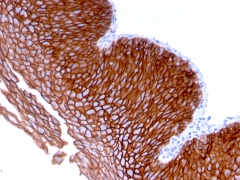 Immunohistochemistry of Desmoglein 3 Antibody Microarray Validated clone DSG3/2839 in human esophageal carcinoma tissue. Formalin-fixed, paraffin-embedded esophageal carcinoma demonstrates strong membranous staining of tumor epithelial cells, consistent with Desmoglein 3 localization at desmosomal cell-cell junctions in stratified squamous epithelium-derived malignancy. Heat-induced epitope retrieval was performed by boiling tissue sections in pH 9 10mM Tris with 1mM EDTA for 10-20 minutes followed by cooling prior to staining. The microarray validated monoclonal antibody clone DSG3/2839 was used as the primary antibody.
