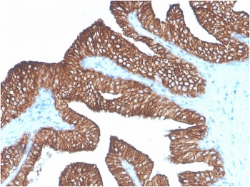 EpCAM Antibody Ber-EP4 Prostate Carcinoma IHC. Immunohistochemistry staining of FFPE human prostate carcinoma with EpCAM antibody (clone Ber-EP4). HIER: boil tissue sections in pH 9 10mM Tris with 1mM EDTA for 10-20 min and allow to cool before testing.