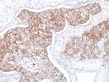 EpCAM Antibody Ber-EP4 Breast Carcinoma IHC. Immunohistochemistry staining of FFPE human breast carcinoma with EpCAM antibody (clone Ber-EP4). HIER: boil tissue sections in pH 9 10mM Tris with 1mM EDTA for 10-20 min and allow to cool before testing.