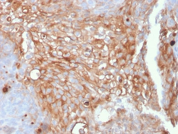 Immunohistochemistry of Uroplakin 1A antibody in human urothelial carcinoma. Formalin-fixed, paraffin-embedded human urothelial carcinoma tissue was stained with microarray validated Uroplakin 1A antibody (clone UPK1A/2925) following heat-induced epitope retrieval by boiling in pH 9 10 mM Tris with 1 mM EDTA for 10-20 minutes and cooling prior to testing. HRP-DAB brown chromogenic signal demonstrates strong membranous staining in tumor cells, consistent with apical membrane localization and urothelial differentiation associated with Uroplakin 1A, while surrounding stromal cells show minimal background staining.