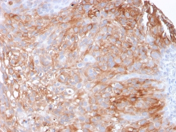 Immunohistochemistry of Uroplakin 1A antibody in human urothelial carcinoma. Formalin-fixed, paraffin-embedded human urothelial carcinoma tissue was stained with microarray validated Uroplakin 1A antibody (clone UPK1A/2925) following heat-induced epitope retrieval by boiling in pH 9 10 mM Tris with 1 mM EDTA for 10-20 minutes and cooling prior to testing. HRP-DAB brown chromogenic signal highlights prominent membranous staining in malignant urothelial cells, consistent with the apical membrane localization and differentiation-associated expression pattern of Uroplakin 1A, while adjacent stromal elements remain largely negative.