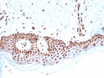 MSH2 Antibody (clone MSH2/2622). Immunohistochemistry analysis of FFPE human basal cell carcinoma using MSH2 antibody (clone MSH2/2622). Strong nuclear brown chromogenic staining identifies MutS homolog 2 / MSH2-positive tumor cells, consistent with nuclear localization of this DNA mismatch repair protein. Heat-induced epitope retrieval was performed by boiling tissue sections in pH 9 10mM Tris with 1mM EDTA for 20 minutes followed by cooling prior to staining.