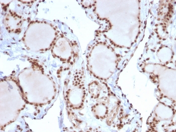MSH2 Antibody (clone MSH2/2622). Immunohistochemistry analysis of FFPE human thyroid carcinoma using MSH2 antibody. Strong nuclear brown chromogenic staining identifies MutS homolog 2 / MSH2-positive tumor epithelial cells, consistent with the expected nuclear localization of this DNA mismatch repair protein. Heat-induced epitope retrieval was performed by boiling tissue sections in pH 9 10mM Tris with 1mM EDTA for 20 minutes followed by cooling prior to staining.