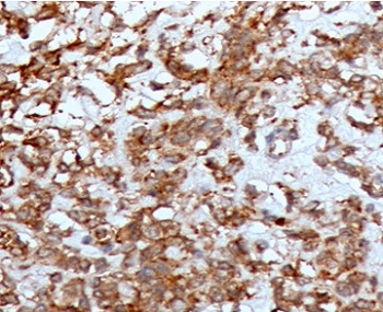 Cathepsin K Tissue Remodeling Protease Antibody Liver Tissue IHC. Immunohistochemistry analysis of FFPE human liver tissue using CTSK Antibody (clone CTO2-1) shows diffuse granular cytoplasmic staining in scattered cell populations, consistent with CTSK / Cathepsin K localization in lysosomal compartments associated with matrix remodeling activity. The punctate staining pattern reflects protease involvement in extracellular matrix turnover, while hepatocytes display comparatively lower background staining. Hematoxylin counterstain provides nuclear contrast and structural context. HIER: boil FFPE tissue sections in pH 9 10 mM Tris with 1 mM EDTA for 10-20 min and allow to cool before testing.