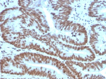 BMI1 Antibody Colon Carcinoma IHC. Immunohistochemistry analysis of FFPE human colon carcinoma tissue using BMI1 antibody clone BMI1/2823. Tumor epithelial cell nuclei demonstrate strong HRP-DAB brown staining consistent with the chromatin-associated localization of BMI1 in polycomb-mediated transcriptional repression, stem cell self-renewal signaling, and epigenetic regulatory pathways active in proliferative colorectal carcinoma tissue. Nuclei are counterstained blue. Heat-induced epitope retrieval was performed by boiling tissue sections in pH9 10 mM Tris with 1 mM EDTA for 20 minutes followed by cooling prior to staining.