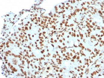 BMI1 Antibody Breast Carcinoma IHC. Immunohistochemistry analysis of FFPE human breast carcinoma tissue using BMI1 antibody clone BMI1/2823. Tumor cell nuclei demonstrate strong HRP-DAB brown staining consistent with the chromatin-associated role of BMI1 in polycomb complex-mediated transcriptional repression, stemness-associated self-renewal signaling, and epigenetic regulation pathways within proliferative breast carcinoma tissue. Nuclei are counterstained blue. Heat-induced epitope retrieval was performed by boiling tissue sections in pH9 10 mM Tris with 1 mM EDTA for 20 minutes followed by cooling prior to staining.