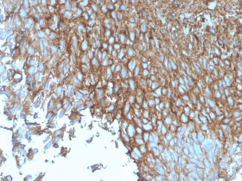 GLUT1 Antibody Recombinant Mouse MAb rGLUT1/2476. Immunohistochemistry analysis of GLUT1 / SLC2A1 in FFPE human bladder tissue demonstrates strong HRP-DAB brown membranous staining in epithelial cells consistent with the plasma membrane localization of the GLUT1 glucose transporter. The staining outlines cell borders across the epithelial layer, highlighting the characteristic membrane-associated distribution of this facilitative glucose transporter in metabolically active cells. Adjacent stromal components show minimal staining, providing contrast to the epithelial signal. Heat induced epitope retrieval was performed by boiling tissue sections in pH 9 10mM Tris buffer with 1mM EDTA for 20 minutes followed by cooling prior to antibody incubation.