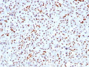 SOX9 Antibody Pancreas IHC. Immunohistochemistry analysis of FFPE human pancreas using SOX9 Antibody. Recombinant rabbit monoclonal antibody clone SOX9/3141R demonstrates strong nuclear HRP-DAB brown staining in pancreatic ductal epithelial cells, clearly highlighting ductal structures within the gland. Acinar cells and surrounding stromal components show minimal staining, supporting specificity for ductal lineage. The observed pattern is consistent with SOX9âs role as a pancreatic ductal marker and regulator of epithelial differentiation. Heat-induced epitope retrieval was performed using pH 9 Tris-EDTA buffer to optimize nuclear antigen detection.