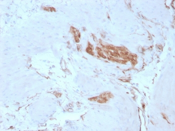 SPTAN1 Antibody for IHC staining of FFPE human colon tissue. HRP-DAB brown cytoplasmic staining is observed in epithelial and stromal cells, consistent with the submembranous cytoskeletal localization of Spectrin alpha chain, non-erythrocytic 1 (Alpha II Spectrin / SPTAN1). The rabbit monoclonal antibody clone SPTAN1/3351 was used for detection. HIER: boil tissue sections in pH 9 10mM Tris with 1mM EDTA for 20 min and allow to cool before testing.