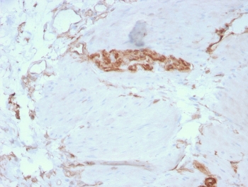 Immunohistochemistry of SPTAN1 antibody in human colon tissue. FFPE human colon shows cytoplasmic HRP-DAB brown staining in epithelial and stromal cells, consistent with Spectrin alpha chain, non-erythrocytic 1 localization along the submembranous cytoskeleton. Clone SPTAN1/3351 was used for detection. Heat-induced epitope retrieval was performed by boiling tissue sections in pH 9 10 mM Tris with 1 mM EDTA for 20 minutes followed by cooling prior to staining.