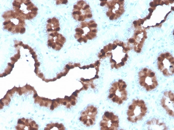 pS2 Antibody Recombinant Mouse MAb rTFF1/1091. Immunohistochemistry analysis of Trefoil factor 1 (TFF1) in formalin-fixed, paraffin-embedded human breast carcinoma tissue using pS2 Antibody Recombinant Mouse MAb rTFF1/1091. Tumor epithelial cells show HRP-DAB brown cytoplasmic staining consistent with expression of the estrogen regulated secretory protein TFF1 (pS2). Hematoxylin counterstain highlights nuclei (blue). Antigen retrieval was performed by boiling tissue sections in pH 9 10mM Tris with 1mM EDTA for 20 min followed by cooling prior to immunohistochemistry staining.