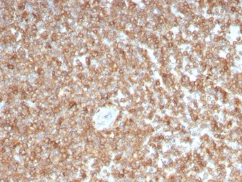 GM-CSF Antibody Lymphoid Tissue IHC. Immunohistochemistry of Granulocyte macrophage colony stimulating factor / CSF2 in FFPE human spleen tissue using mouse monoclonal GM-CSF antibody, clone CSF2/3403. HRP-DAB brown staining highlights cytoplasmic labeling in immune cell populations within splenic white pulp regions, consistent with cytokine expression in lymphoid tissue, while surrounding areas show lower background staining and nuclei are counterstained blue. Heat induced epitope retrieval was performed by boiling tissue sections in pH 9 10 mM Tris with 1 mM EDTA for 10-20 min followed by cooling prior to staining.