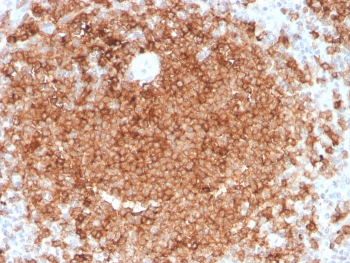 GM-CSF Antibody Lymphoid Follicle IHC. Immunohistochemistry of Granulocyte macrophage colony stimulating factor / CSF2 in FFPE human spleen tissue using mouse monoclonal GM-CSF antibody, clone CSF2/3403. HRP-DAB brown staining highlights dense cytoplasmic labeling within lymphoid follicle regions, with strong signal in clustered immune cells consistent with localized cytokine expression, while surrounding splenic tissue shows lower background staining and nuclei are counterstained blue. Heat induced epitope retrieval was performed by boiling tissue sections in pH 9 10 mM Tris with 1 mM EDTA for 10-20 min followed by cooling prior to staining.