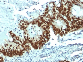 p53 Antibody Clone DO-1 / TP53 Tumor Suppressor Antibody. Immunohistochemistry analysis of FFPE human colon carcinoma tissue demonstrates strong nuclear staining of tumor epithelial cells using p53 Antibody Clone DO-1. The HRP-DAB brown chromogenic signal highlights nuclear localization of Tumor protein p53 within malignant epithelial cells, while surrounding stromal cells show comparatively weaker staining. Heat-induced epitope retrieval was performed by boiling tissue sections in pH 9 10 mM Tris with 1 mM EDTA for 10-20 minutes followed by cooling prior to staining.